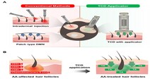 연세대-주빅, 마이크로니들 기술 기반 원형탈모 치료제 개발