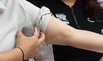 오염수 방류 반대하다 한국경찰에 피멍든 팔 [포토]