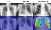 엑스레이 사진만으로도 ‘코로나19’ 정확한 진단