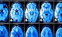 40년 새 ‘훅’ 커진 사람의 뇌…치매 발병률도 감소?