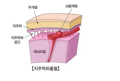 지주막하출혈. 서울아산병원 누리집 갈무리