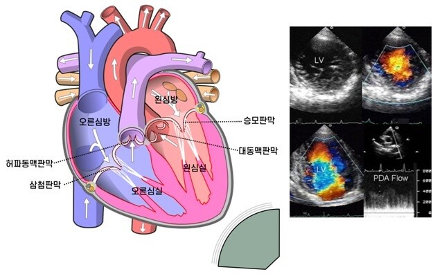 오른쪽 그림: 심장의 구조와 피의 흐름(화살표 방향). 왼쪽 그림: 도플러 초음파 검사기로 피의 흐름의 색깔로 나타낸 심장 영상 (일부 그림 출처: Wikimedia Commons)