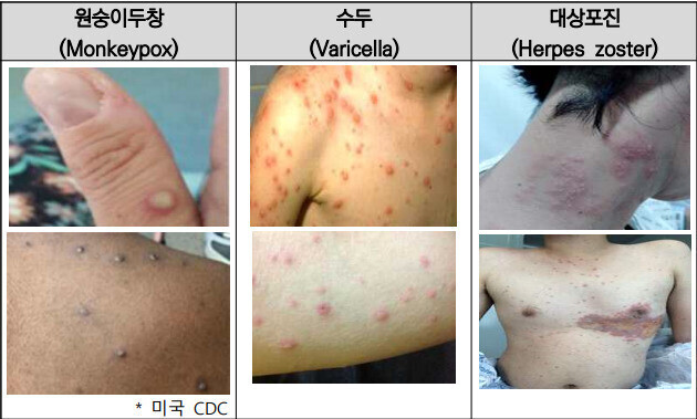 원숭이두창과 임상 증상이 비슷한 질환들. 질병관리청 ‘원숭이두창대응 지침’.