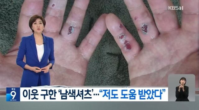 지난 15일 ‘오송 궁평 지하차도 사고’ 현장에서 총 3명을 구조한 충북 증평군청 공무원인 정영석씨의 손 곳곳이 쓸려 있다. 지난 17일 방송된 ＜한국방송＞(KBS) ‘남색 셔츠’ 구조자 찾았다…“나도 도움 받았다” 보도. 방송화면 갈무리