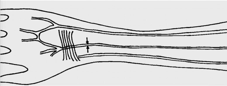 팔에 있는 3개의 동맥. 가운데 화살표 표시한 것이 정중 동맥이다. Credit: Prof. Dr. Hab. Maciej Henneberg, University of Zurich