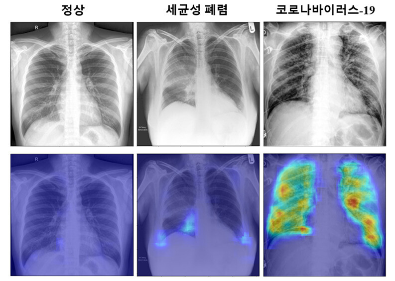 코로나19 진단 새 알고리즘을 통해 얻은 코로나19 확률 분포 특징 지도. 다른 병변에서는 의심되는 영역이 거의 나타나지 않았으나 코로나19의 경우 고화질로 의심이 되는 부분이 표시되는 것을 볼 수 있다. 카이스트 제공