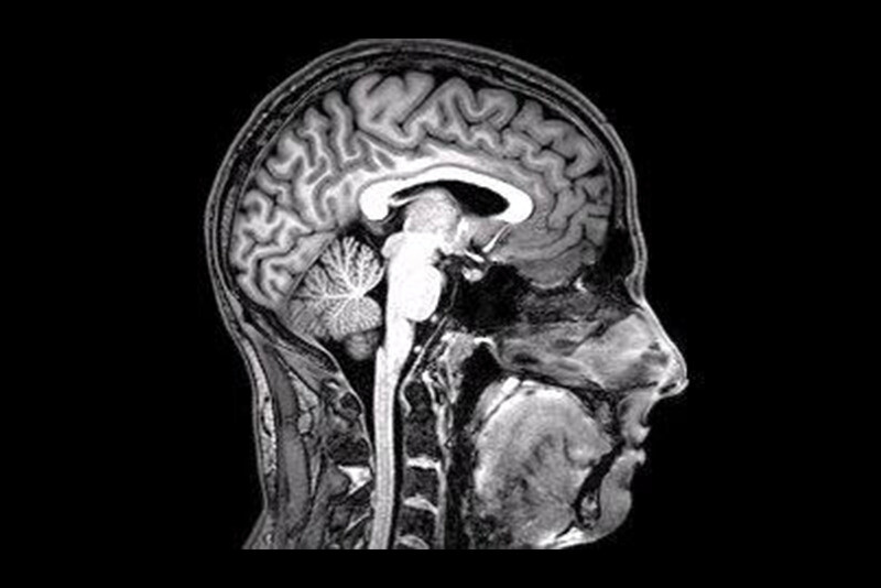 뇌의 MRI 촬영 사진. 위키미디어 코먼스