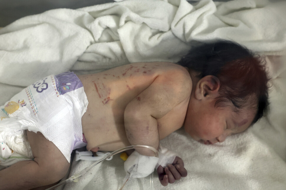 7일(현지시각) 시리아 북부 한 가정집 잔해에서 탯줄을 단 채 발견된 신생아가 알레포 아프린의 한 병원으로 옮겨져 치료를 받고 있다. 아기의 몸에 그 과정에서 입은 것으로 보이는 상처들이 나있다.아프린/AP 연합뉴스