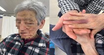 요양원이 폭행 방임했나…구청, 85살 치매환자 사망 조사