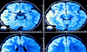 40년 새 ‘훅’ 커진 사람의 뇌…치매 발병률도 감소?