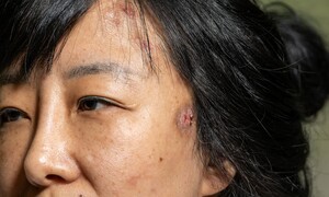 “고엽제 2세 후유증, 딱 세 질환만 인정… 이마저 ‘원님 재판’”