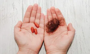 ‘청년 탈모 건보 적용’ 논란 속 중증 원형탈모 치료제 건보 지원 확대