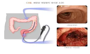 궤양성 대장염, 의사-환자가 공동결정하는 게 중요 [건강한겨레]