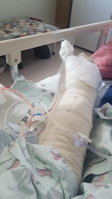 한국에서 일한 마지막 식품가공 공장에서 필자는 기계를 청소하다가 손이 끼여 눌렸다. 수술을 여러번 했고, 지금도 치료를 받고 있다. 필자 제공