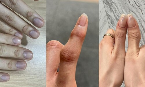 “손가락 기형에 퇴행성관절염” 삼성반도체 노동자 증언 이어져