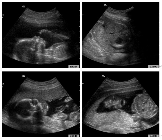 위 오른쪽 사진을 제외한 나머지 사진은 5개월 된 태아의 초음파 사진이다. 위 오른쪽 사진은 성인의 명치 부근 초음파 사진이다. 한겨레 자료