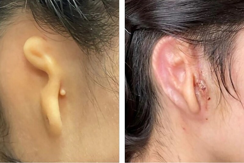 시술 전의 소이증 귀(왼쪽)와 이식하고 30일이 지난 뒤의 3D프린팅 귀(오른쪽). 아르투로 보니야 박사 제공/뉴욕타임스에서 인용