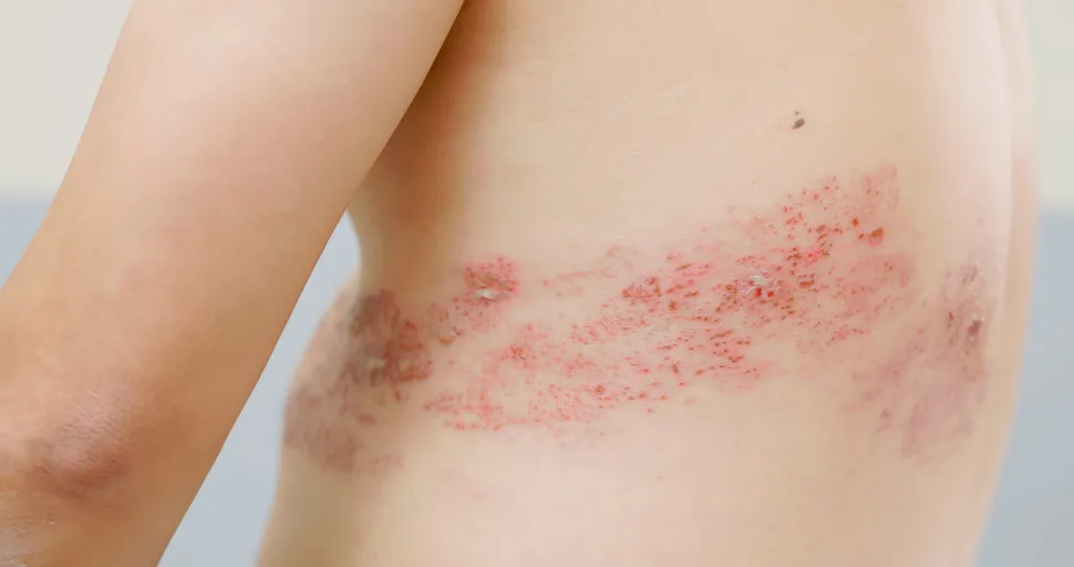 대상포진 후유증 악순환, 끊어낼 수 있습니다! 예방 백신으로 평생 고통에서 벗어나세요