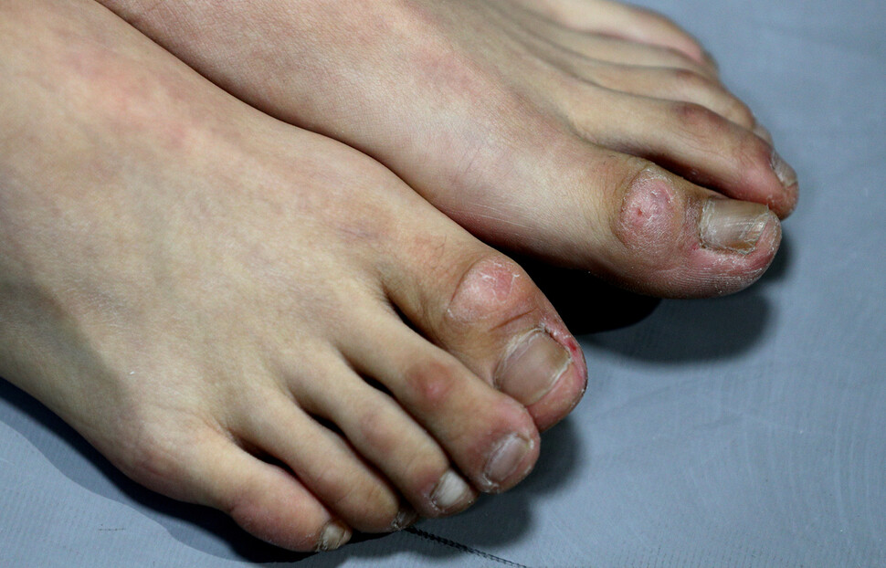 曲がりくねってたこで覆われたソ・チェヒョンの足の親指。 キム・ボンギュ、シニアスタッフレポーターbong9@hani.co.kr