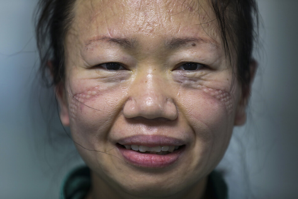 우한 진인탄병원에서 코로나19 환자를 돌봐온 간호사가 2월16일 마스크를 벗자 깊은 자국이 얼굴에 남아 있다.