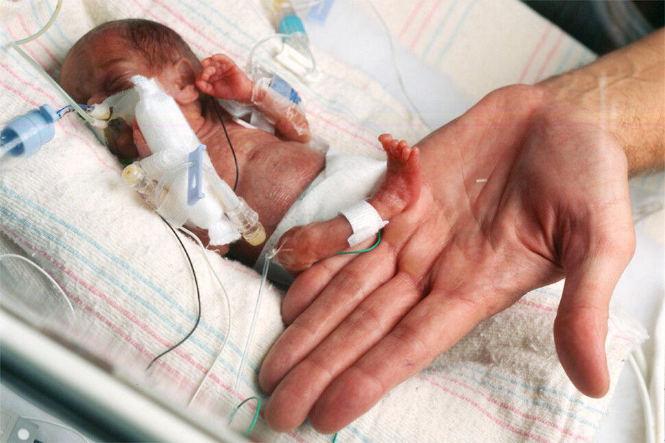 미국 일리노이에서 태어난 저체중 아기 다리 밑으로 의사가 손을 대보고 있다. REUTERS 연합
