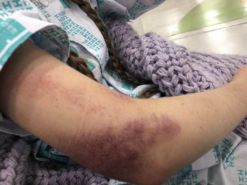 로네 옐메씨가 2022년 10월29일 서울 용산구 이태원동에서 참사 피해를 입고 병원에 가서 자신의 부상 부위를 찍은 사진이다. 로네 옐메 제공