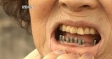 韓国 老人インプラント 2本まで健康保険適用
