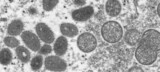 韓国、サル痘疑われる患者２人確認…「国内感染」ではなく入国前に症状発現