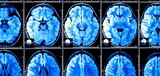 ４０年間で大きくなった人間の脳…認知症の発病率も減少か